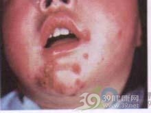  新生儿暂时性脓疱性黑变病：病理特征与诊疗路径解析 健康养生