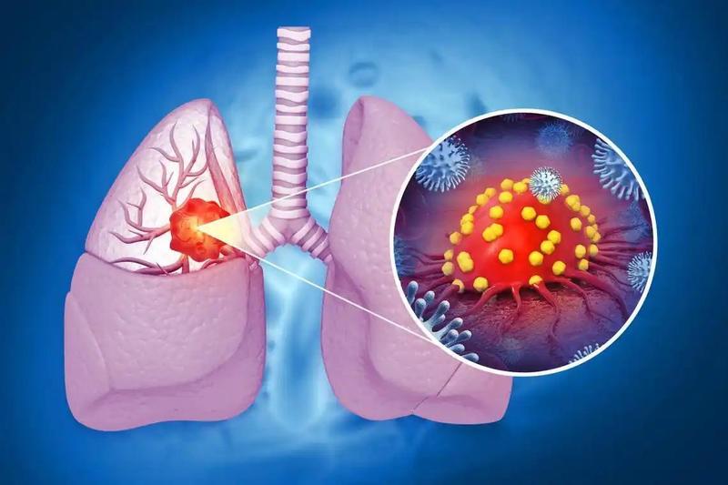 肺癌高危因素指南:饮食与环境的深度解析 健康养生